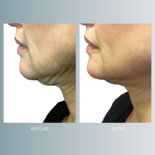 将图片加载到图库查看器,ThermageFLX | up to 20% OFF