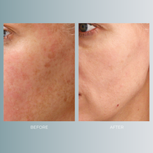 将图片加载到图库查看器,Microneedling | 35% OFF