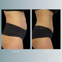 将图片加载到图库查看器,EmSculpt | 40% OFF