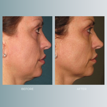 将图片加载到图库查看器，Ultherapy  | up to 20% OFF
