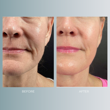 将图片加载到图库查看器，Morpheus8 | 30% OFF
